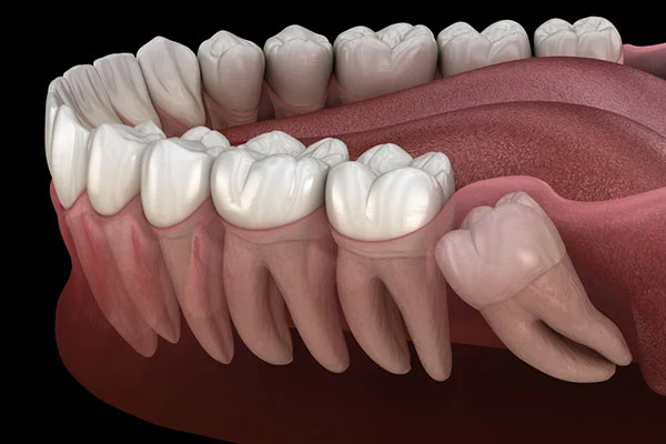 An image depicting a person holding their jaw in discomfort, highlighting the financial strain of wisdom tooth removal without insurance.